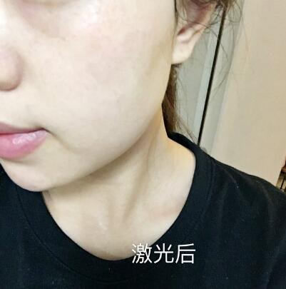 紹興維美整形激光祛斑兩個(gè)療程，皮膚像剝了殼的雞蛋