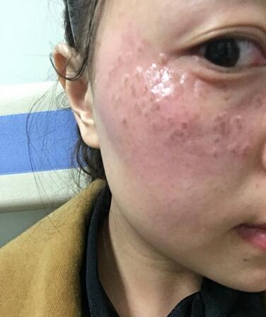 紹興維美整形激光祛斑兩個(gè)療程，皮膚像剝了殼的雞蛋