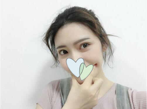 哈爾濱成美自體脂肪全臉填充案例，果然還是飽滿顯年輕