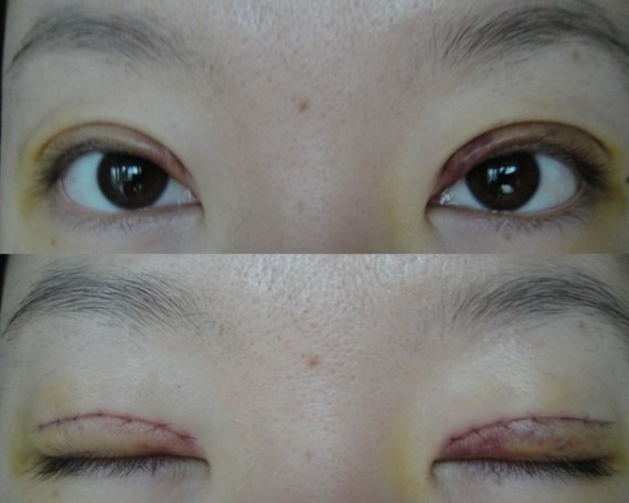 在鄭州望京做全切雙眼皮+開外眼角，術(shù)后效果確實(shí)沒(méi)讓我失望