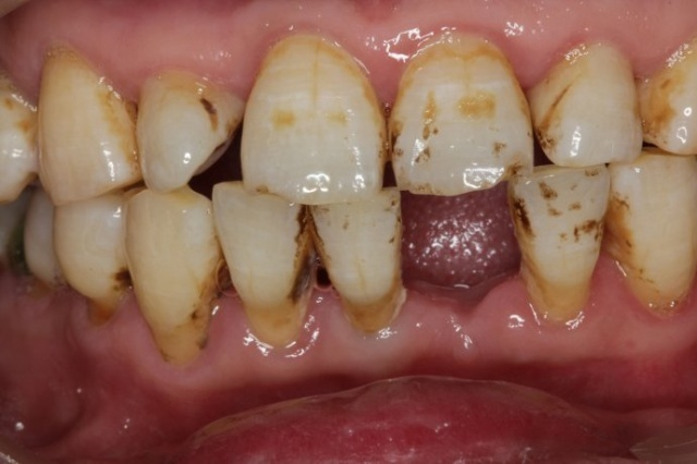 深圳正夫口腔種植牙案例分享，這下可以好好吃飯了