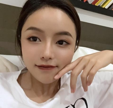 廈門新生植發(fā)種植發(fā)際線半年效果分享，一鍵get高顱頂