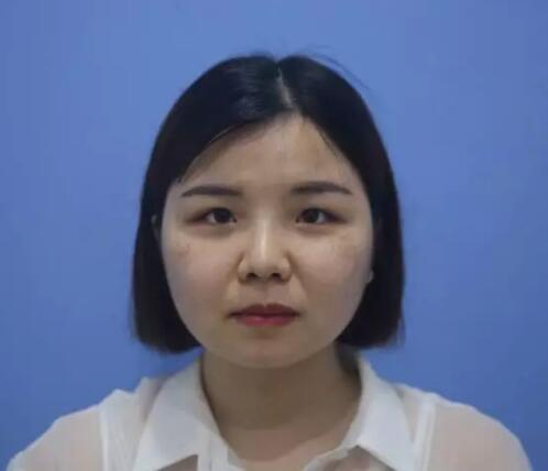 長沙星雅整形激光祛斑三個月效果分享，白白凈凈誰看了不愛