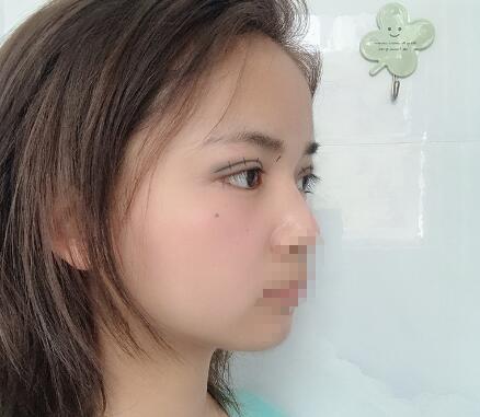 長沙愛思特整形定點(diǎn)雙眼皮5天 長沙愛思特整形定點(diǎn)雙眼皮5天