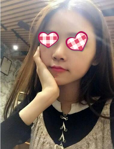 北京葉子整形膨體隆鼻兩個月效果分享，高級感側顏殺