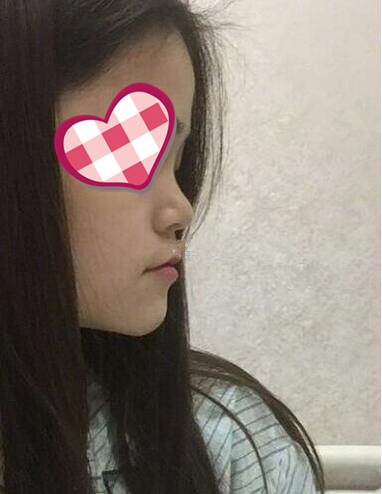 北京葉子整形膨體隆鼻兩個月效果分享，高級感側顏殺