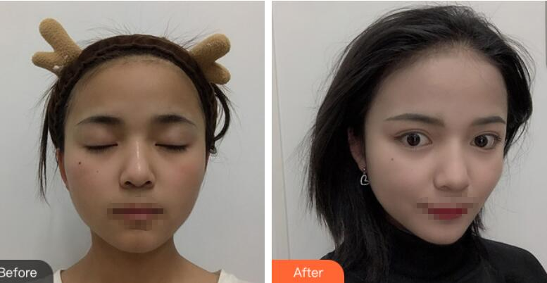 長(zhǎng)沙愛(ài)思特整形定點(diǎn)雙眼皮案例分享，蘿莉到御姐的轉(zhuǎn)變