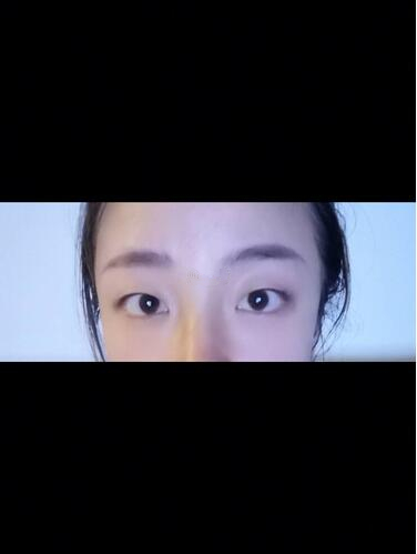 西安時(shí)光整形郭淑華雙眼皮案例分享，一個(gè)月就這么自然