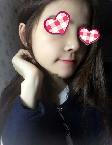 北京葉子整形膨體隆鼻術(shù)后兩個月效果