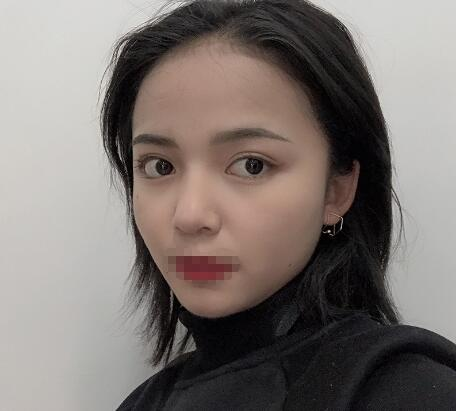 長(zhǎng)沙愛(ài)思特整形定點(diǎn)雙眼皮案例分享，蘿莉到御姐的轉(zhuǎn)變