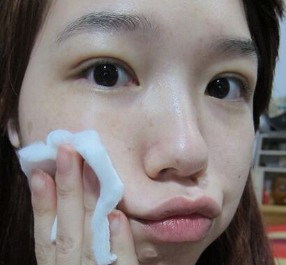 宜昌蕾帝整形張景雷雙眼皮案例分享