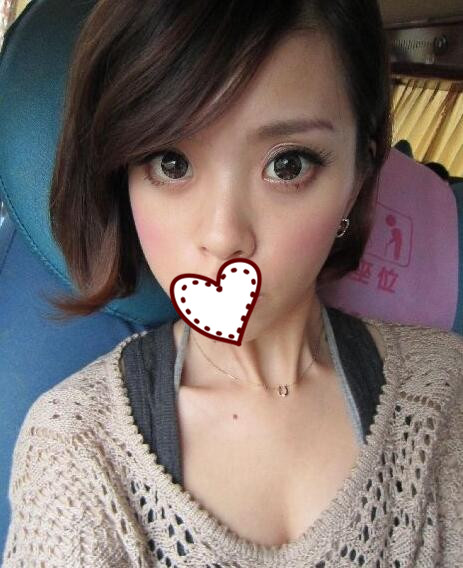 鄭州蘊(yùn)美整形玻尿酸隆鼻案例分享，效果即刻看得見