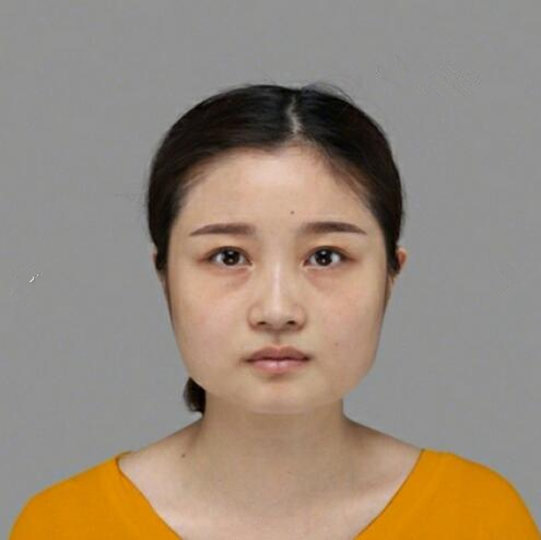 重慶美聯(lián)臣下頜角整形術后三個月效果反饋，一定要忌嘴