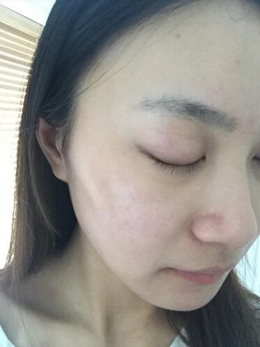 合肥艾雅整形紅藍(lán)光祛痘兩個療程效果，痘痘都消失了