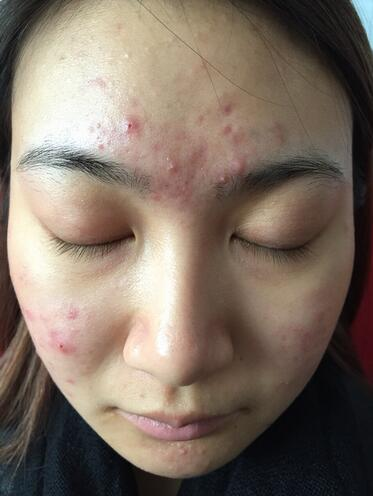 合肥艾雅整形紅藍(lán)光祛痘兩個療程效果，痘痘都消失了