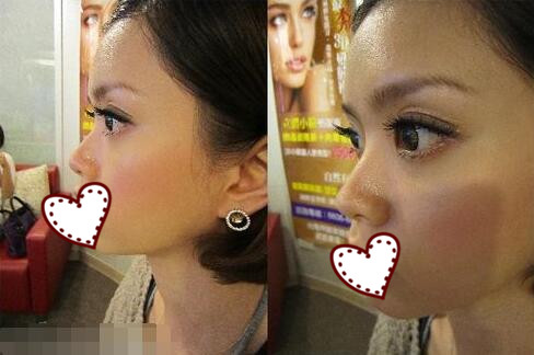 鄭州蘊(yùn)美整形玻尿酸隆鼻案例分享，效果即刻看得見