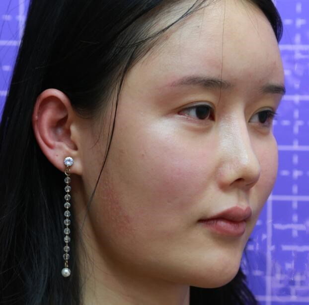 長(zhǎng)沙亞韓整形陳明松下頜角案例分享