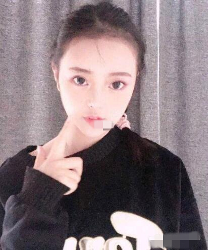 上海首爾麗格整形安建榮V-LINE瓜子臉手術(shù)三個月效果