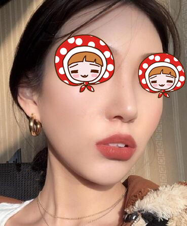 青島華諾整形歪鼻矯正術(shù)后一個月效果