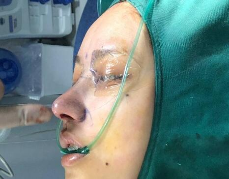 北京圣嘉榮整形呂玲玲硅膠隆鼻案例分享