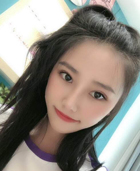 煙臺(tái)華怡整形張上海切開雙眼皮案例分享