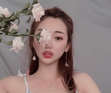 安徽省立醫(yī)院褚燕軍埋線雙眼皮術(shù)后一個月效果分享