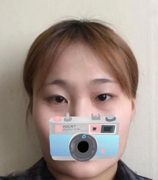 重慶華美整形下頜角整形術(shù)后三個月效果分享