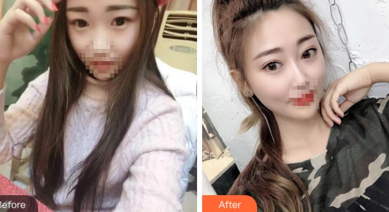 安徽省立醫(yī)院褚燕軍埋線雙眼皮術(shù)后一個月效果分享