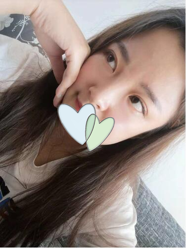 青島伊美爾劉長發(fā)做雙眼皮怎么樣？