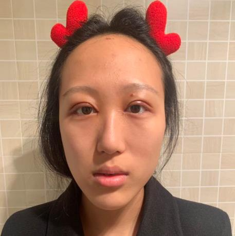 上海華美醫(yī)療美容醫(yī)院楊亞益做眼部修復(fù)整形怎么樣？