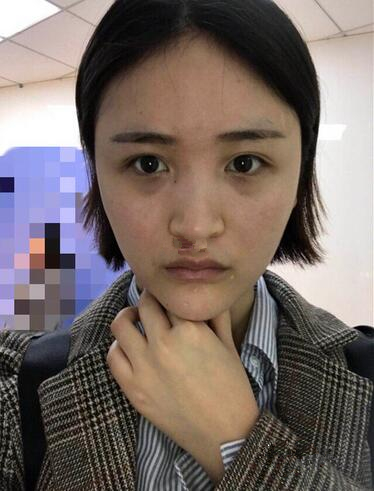 濟南鵬愛整形醫(yī)院怎么樣？濟南鵬愛王飏隆鼻案例分享