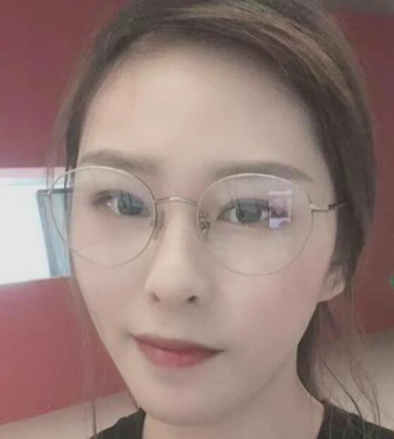 濟南海峽整形醫(yī)院陳娜醫(yī)生激光祛斑案例分享