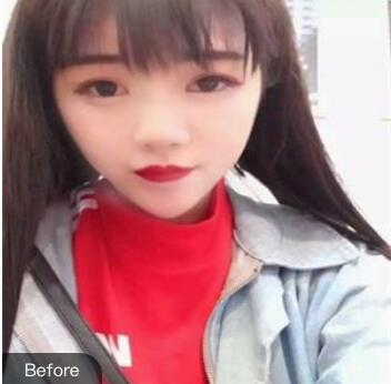 寧波熙美連桂賓醫(yī)生玻尿酸注射隆鼻案例效果對比圖