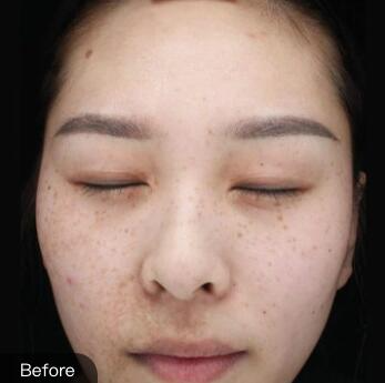 濟南海峽整形醫(yī)院陳娜醫(yī)生激光祛斑案例分享