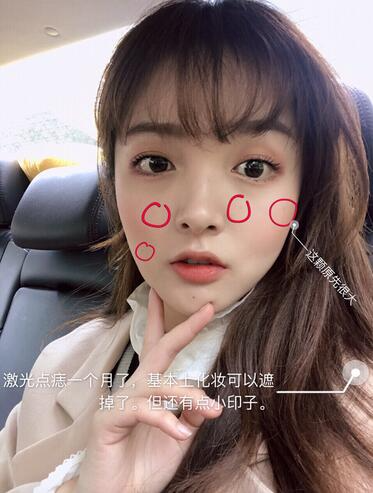 北京蕾士悅丁香醫(yī)生激光點(diǎn)痣案例效果分享