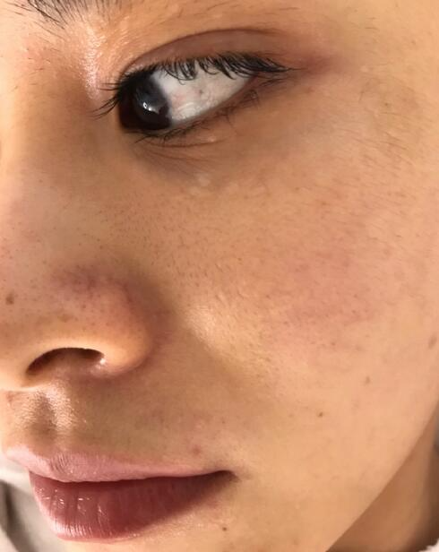 福州愛思特比華利整形林秋蓉醫(yī)生做光子嫩膚過程體驗！皮膚Q彈