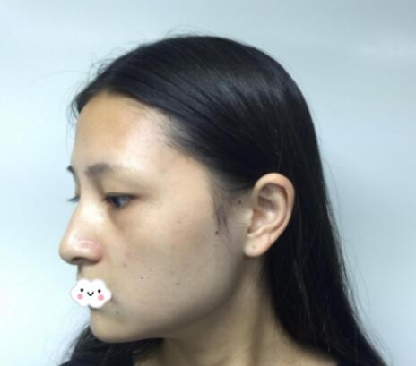 重慶美聯(lián)臣洪政槿醫(yī)生V臉整形案例效果圖對(duì)比