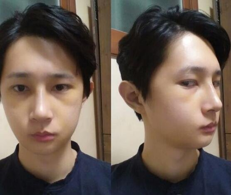 重慶三峽中心醫(yī)院頜面外科張宇下頜角案例手術(shù)效果對(duì)比圖