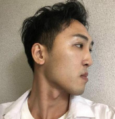 成都恩喜醫(yī)學(xué)整形張曉琴醫(yī)生男性過(guò)大下頜角磨骨案例效果分享