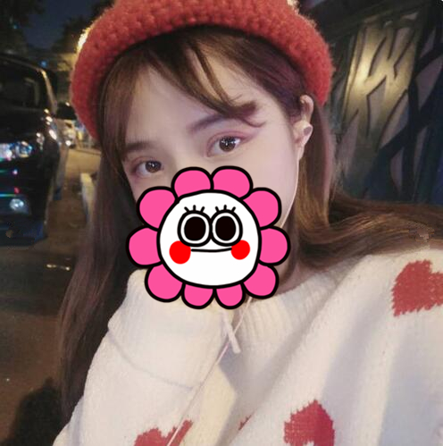 三亞維多利亞整形葉濤醫(yī)生切開雙眼皮案例效果對比圖