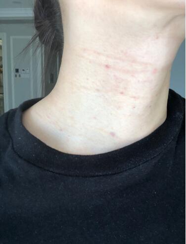 做完液態(tài)超聲刀注意什么。