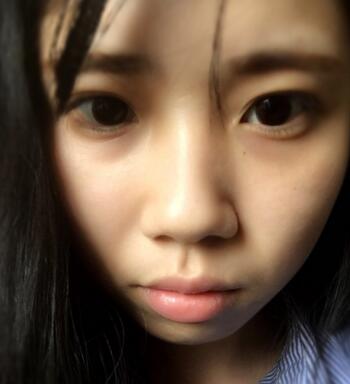 做完鼻骨縮窄手術七天后的樣子 做完鼻骨縮窄手術七天后的樣子