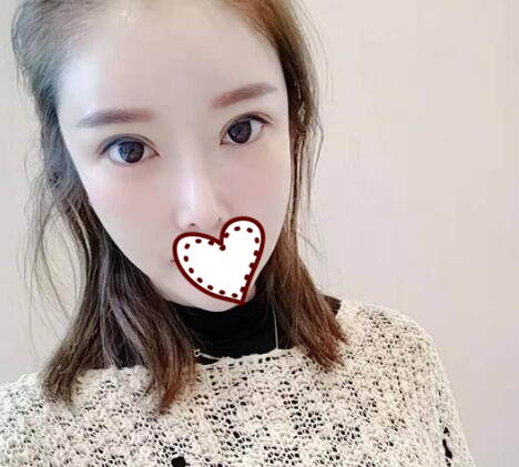 北京亞奇龍醫(yī)療整形醫(yī)生陳煥然雙眼皮案例效果對(duì)比圖