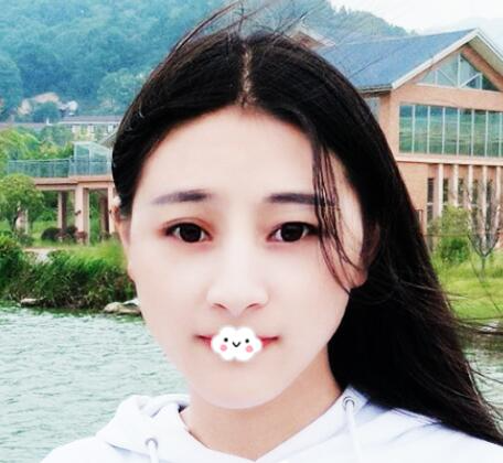 重慶美聯(lián)臣洪政槿醫(yī)生V臉整形案例效果圖對(duì)比