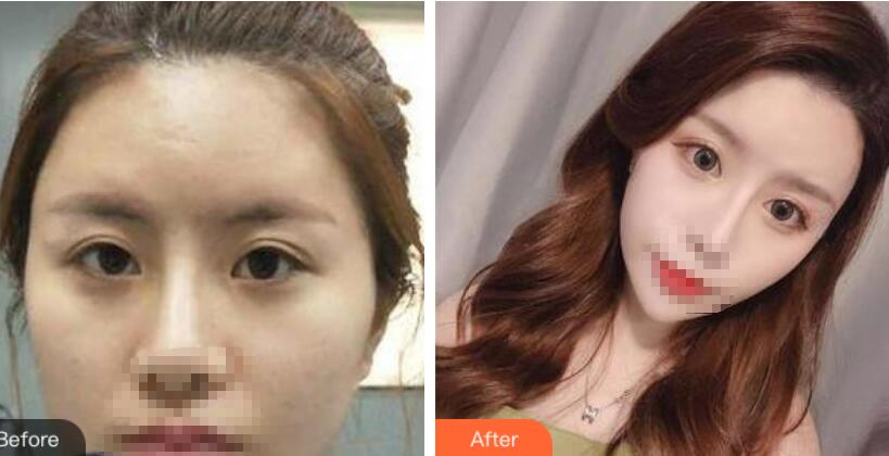 鄭州風(fēng)信子整形美容醫(yī)院雙眼皮案例效果對(duì)比圖分享