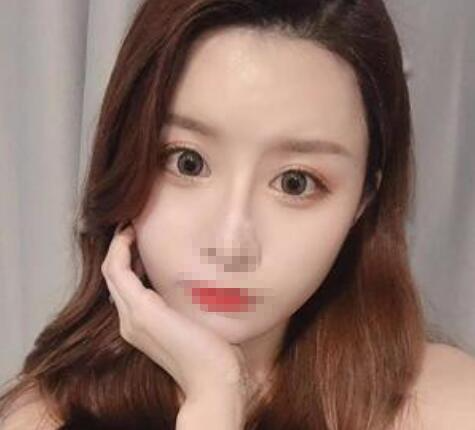 鄭州風(fēng)信子整形美容醫(yī)院雙眼皮案例效果對(duì)比圖分享