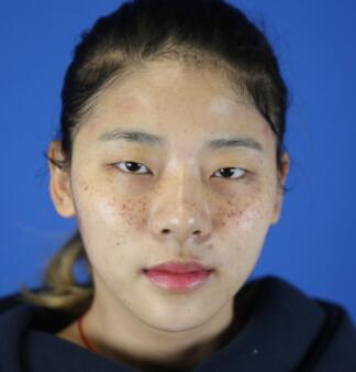 福州愛思特比華利整形林秋榮激光祛斑效果太贊了，終于沒人叫我“斑花”了