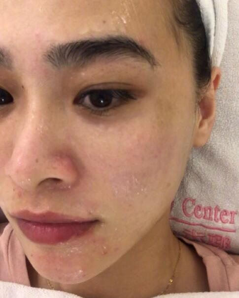 福州愛思特比華利整形林秋蓉醫(yī)生做光子嫩膚過程體驗！皮膚Q彈