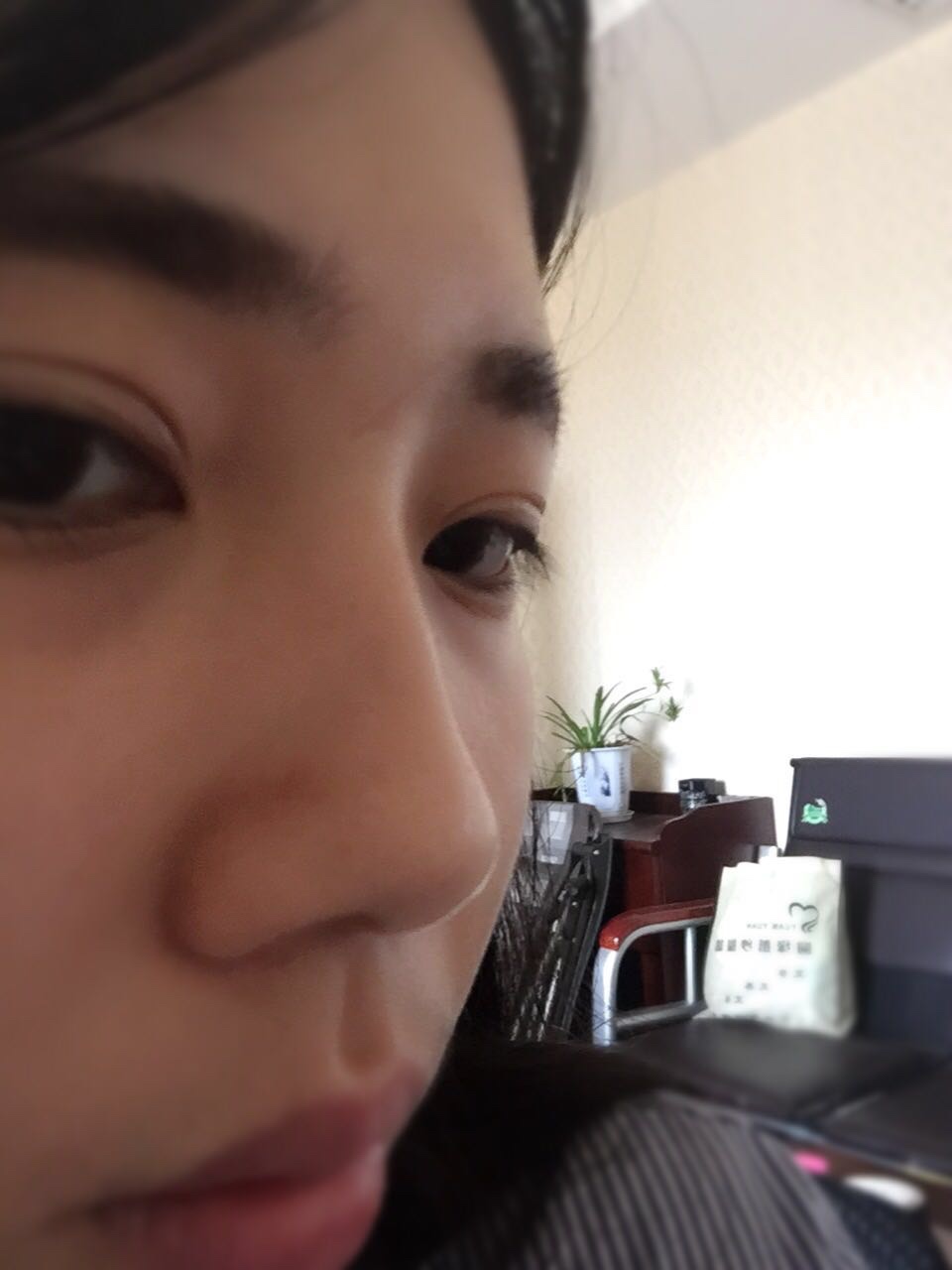 做完鼻骨縮窄手術一個多月的樣子 做完鼻骨縮窄手術一個多月的樣子