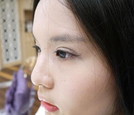 青島大學(xué)醫(yī)學(xué)院整形美容科陳振宇醫(yī)生做雙眼皮怎么樣？案例效果太驚艷